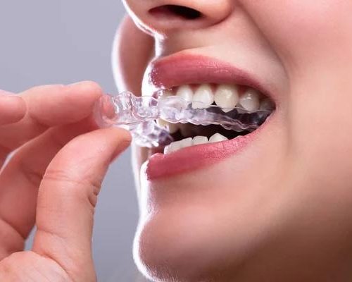Is Invisalign Right for Your Teen or Adult What You Need to Know