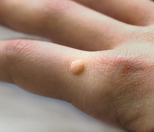 Mole Removal Fast Recovery Options